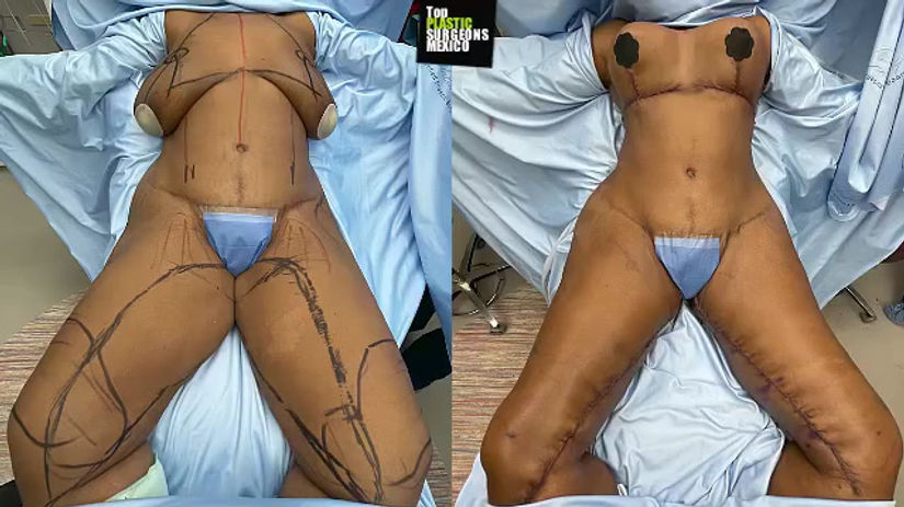 FULL BODY LIFT (Breast Lift + 360° Extended Tummy Tuck + Buttock Lift Inner + Thigh lift)
